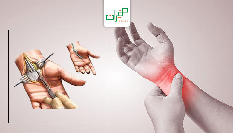 عملية تسليك أعصاب اليد