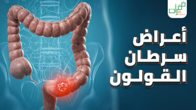 تعرف على أعراض سرطان القولون