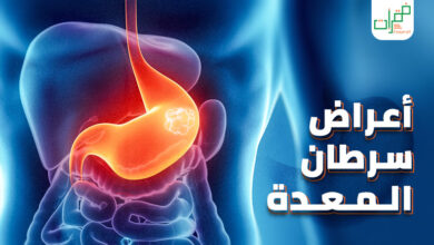 تعرف على أعراض سرطان المعدة