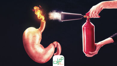 حرقان المعدة