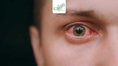 التهاب ملتحمة العين التحسسي